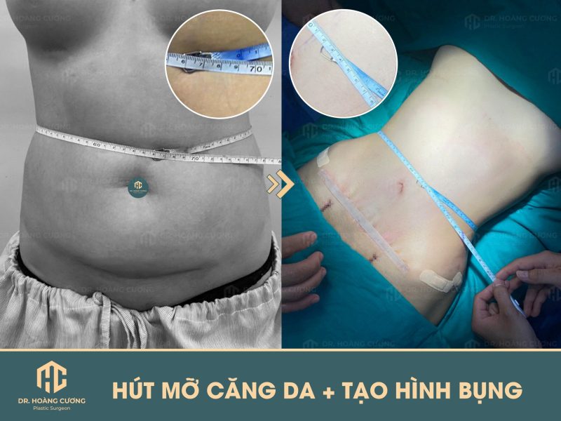 Hút Mỡ Bụng Kiêng Quan Hệ Bao Lâu? Tất Tần Tật Thông Tin Cần Biết