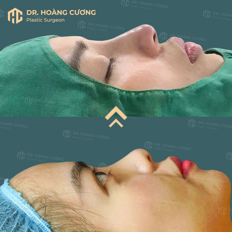 Hình ảnh khách hàng trước và sau nâng mũi tại TM Hoàng Cương